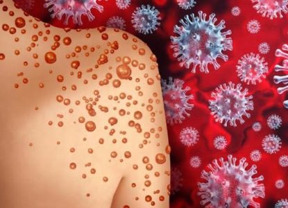 Feira de Santana registra primeiro caso de varíola dos macacos. Bahia tem 21 casos.