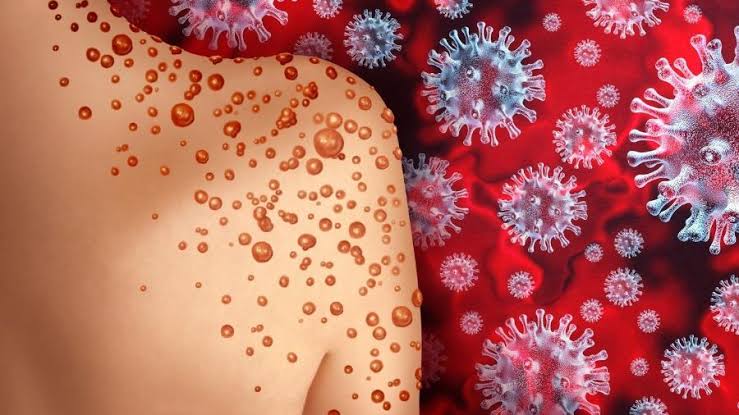 Feira de Santana registra primeiro caso de varíola dos macacos. Bahia tem 21 casos.